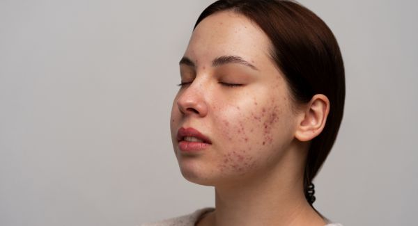 Tratamientos Antiacné