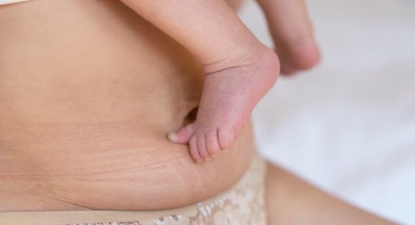 Tratamiento para Estrías